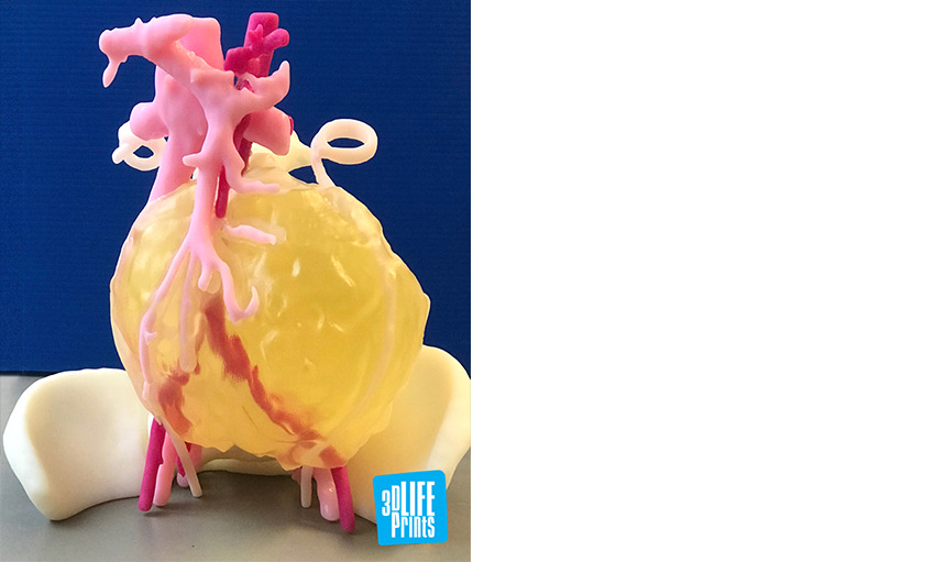 3D printed replica of the patient’s anatomy and tumor