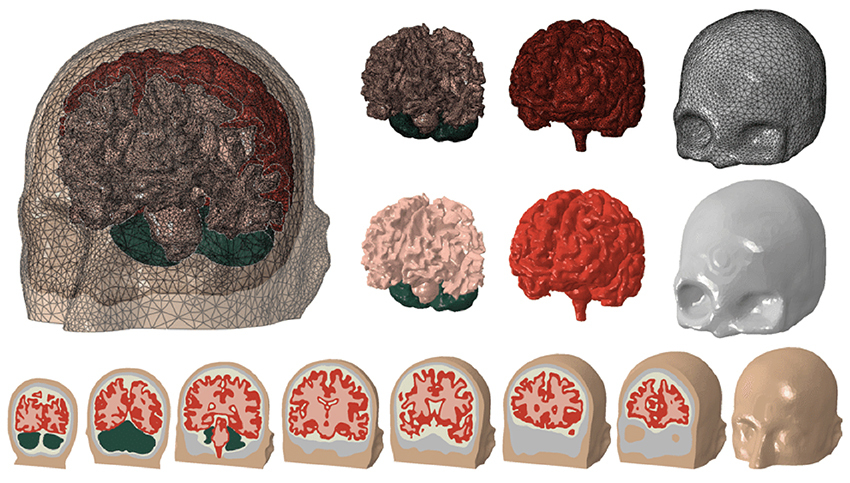Simplewareソフトウェアでの頭蓋骨と脳のセグメンテーション| Synopsys