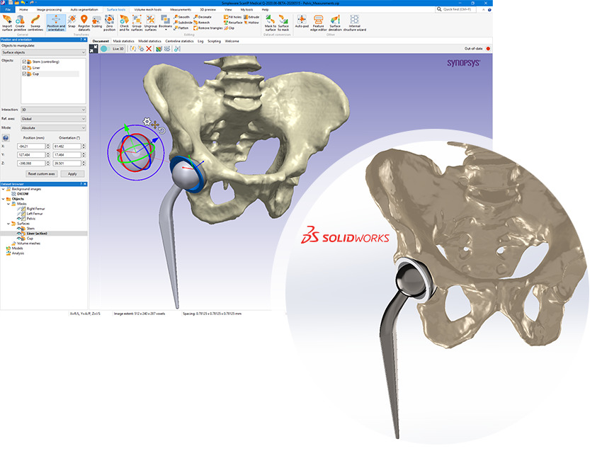 Hip implant design workflow with Simpleware Design Link and SOLIDWORKS
