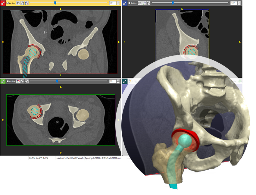 EPositioning of a hip stem, ball and cup in Simpleware CAD