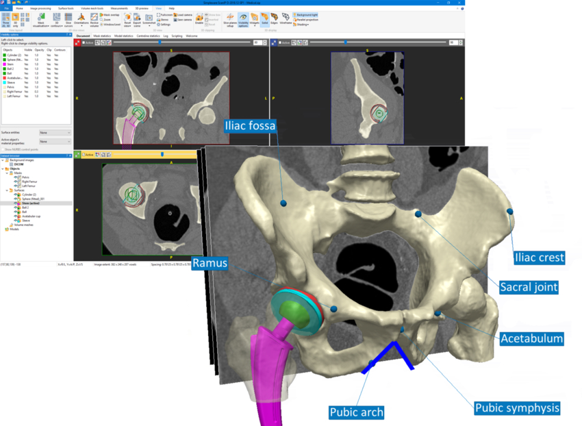 Segmentation of a hip using Simpleware 3D image processing software