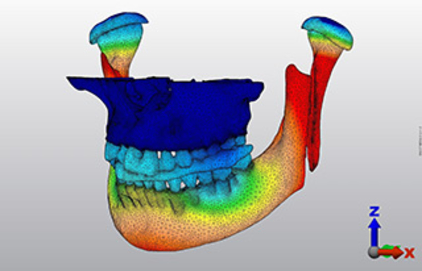Stress analysis: distribution of force applied to the jaw after surgery