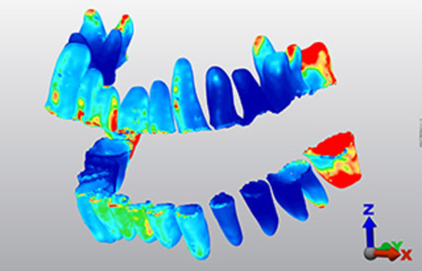 Modeling of tooth movement