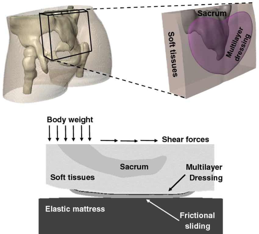 Modeling Prophylactic Sacral Dressings Synopsys Simpleware
