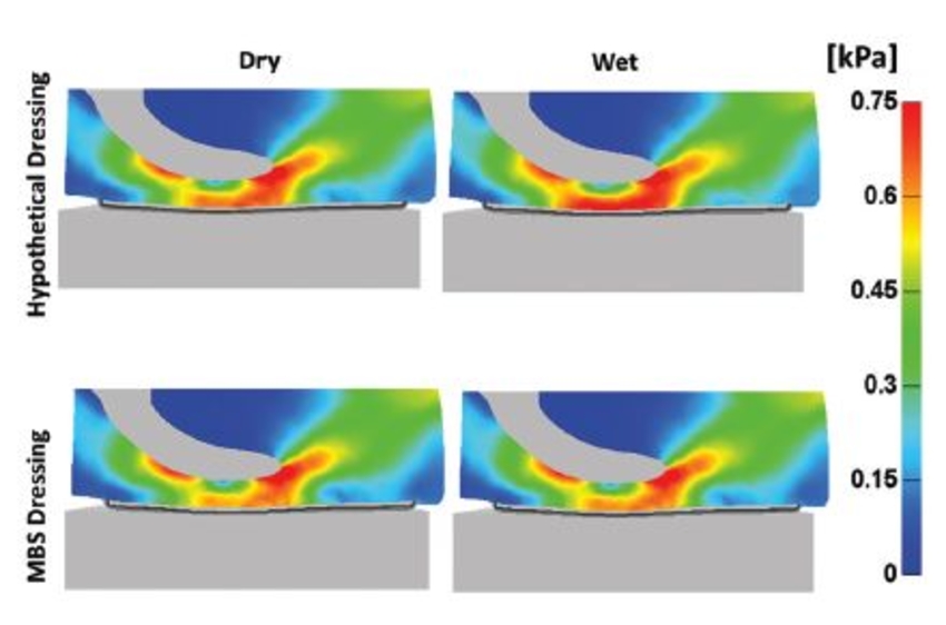 Modeling Prophylactic Sacral Dressings Synopsys Simpleware