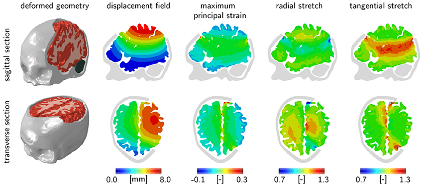 Midline shift for three different scenarios of brain swelling