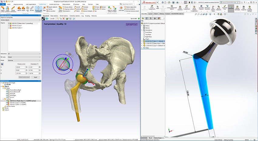 Push or pull changes between SOLIDWORKS® and Simpleware ScanIP for designing a patient-specific hip implant