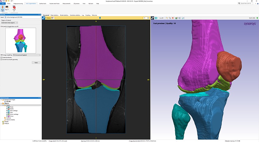 Knee segmentation in Simpleware AS Ortho