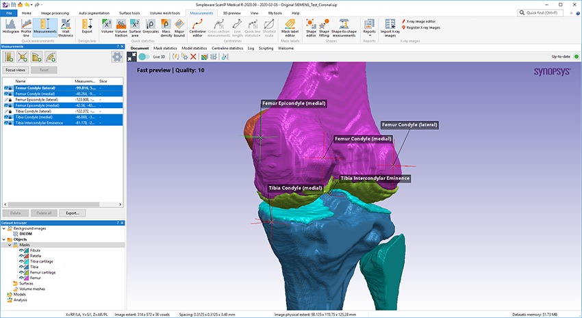 Landmarking of the knee anatomies in Simpleware AS Ortho