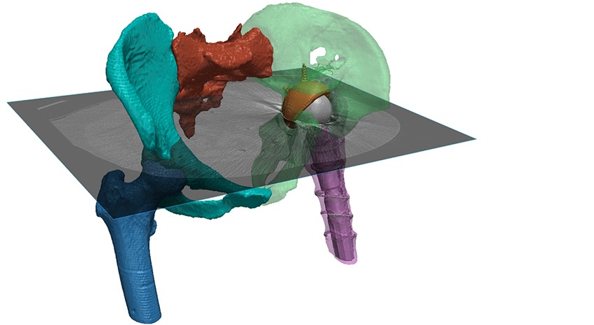 Simpleware AS Ortho segmentation of a hip with implant