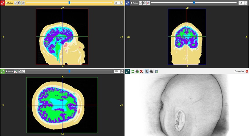 Segmentation and 3D editing of a human head from MRI using Simpleware ScanIP