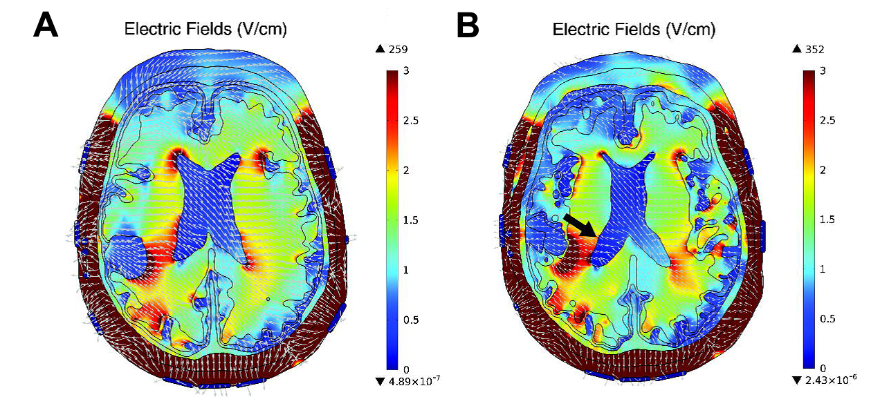 Modeling Alternating Electric Fields for Brain Tumor Treatment